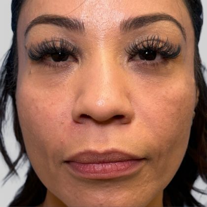 Dermal Filler Before & After Patient #3517