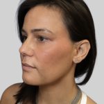 Dermal Filler Before & After Patient #3462