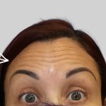 Botox Before & After Patient #3463