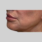 Dermal Filler Before & After Patient #3465