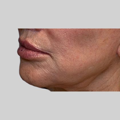 Dermal Filler Before & After Patient #3465