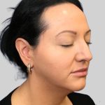 Dermal Filler Before & After Patient #3466