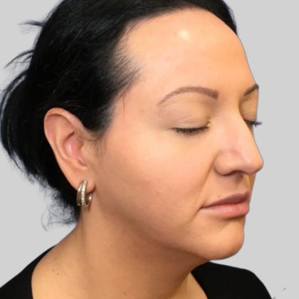 Dermal Filler Before & After Patient #3466