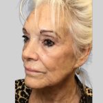 Dermal Filler Before & After Patient #3477
