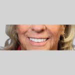 Dermal Filler Before & After Patient #3512