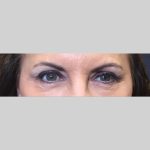 Botox Before & After Patient #3455