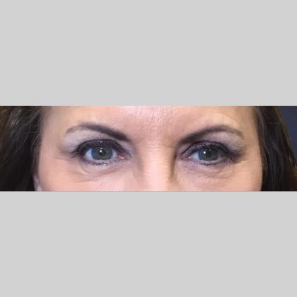 Botox Before & After Patient #3455