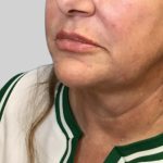 Dermal Filler Before & After Patient #3513