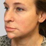 Dermal Filler Before & After Patient #3514
