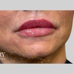 Dermal Filler Before & After Patient #3515