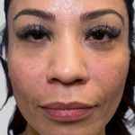 Dermal Filler Before & After Patient #3517