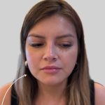 Botox Before & After Patient #3454