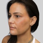 Dermal Filler Before & After Patient #3462