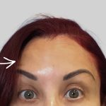 Botox Before & After Patient #3463