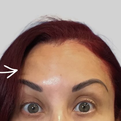 Botox Before & After Patient #3463