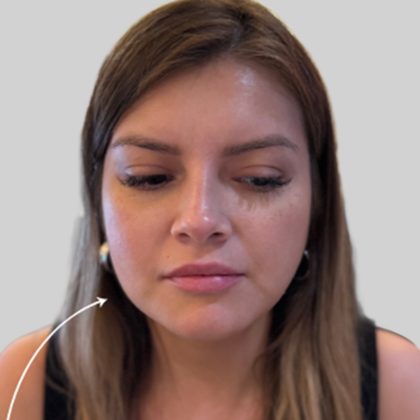 Botox Before & After Patient #3454