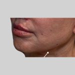 Dermal Filler Before & After Patient #3465