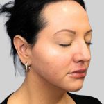 Dermal Filler Before & After Patient #3466