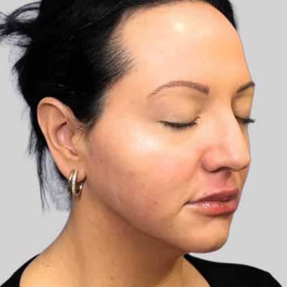 Dermal Filler Before & After Patient #3466