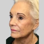 Dermal Filler Before & After Patient #3477