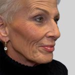 Dermal Filler Before & After Patient #3478