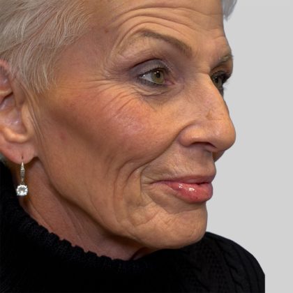 Dermal Filler Before & After Patient #3478