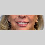 Dermal Filler Before & After Patient #3512