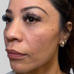 Dermal Filler Before & After Patient #3517