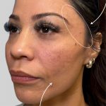 Dermal Filler Before & After Patient #3517