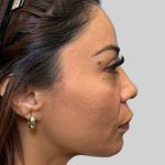 Dermal Filler Before & After Patient #3517
