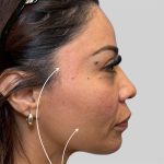 Dermal Filler Before & After Patient #3517