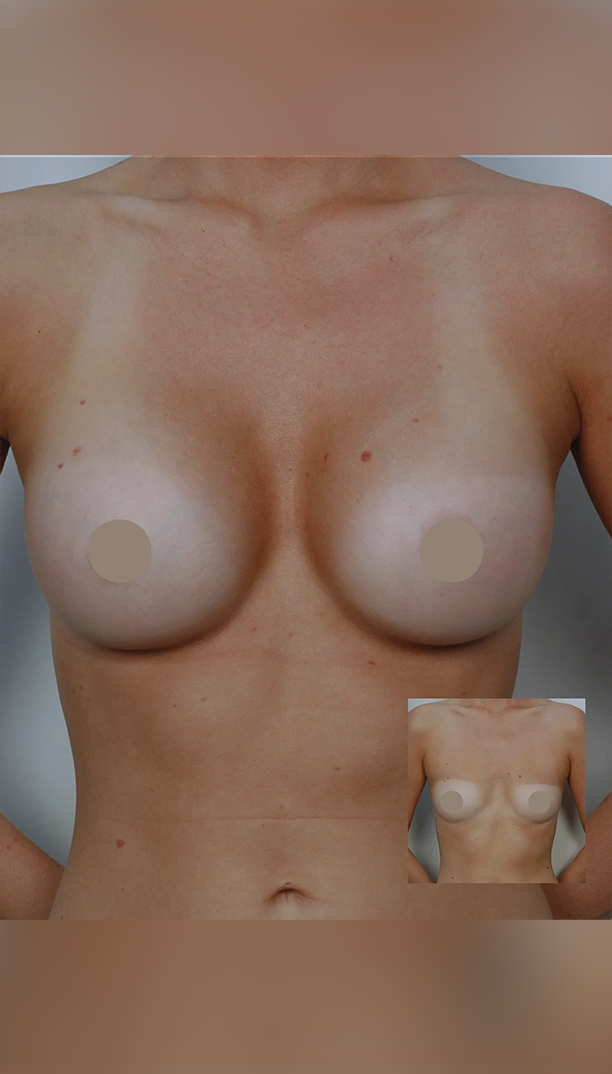 Breast Augmentation